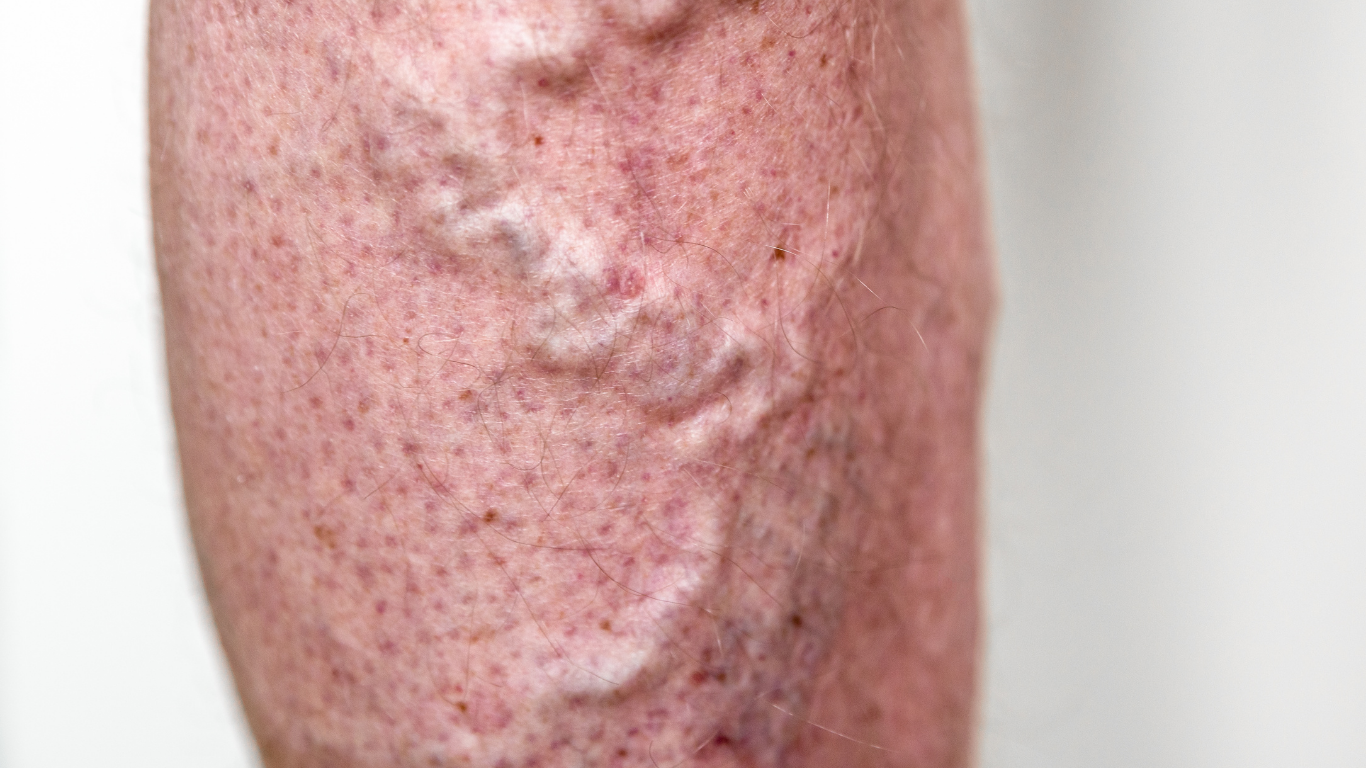 🩸 ¿Arañas vasculares o venas varicosas? Te explico las diferencias (y por qué es importante saberlo) 💙
